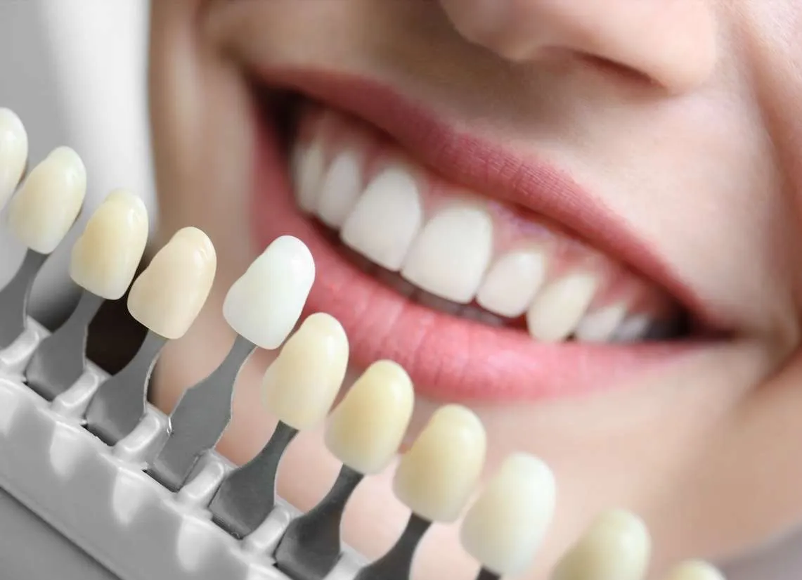 Bleaching Bad Homburg - Professionelle Zahnaufhellung für schöne, weiße Zähne bei DENTICATION