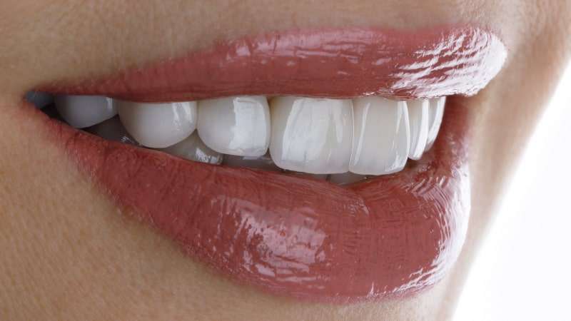 Hauchdünne Veneeers zur Zahnverschönerung bei Dentication Zahnarzt Bad Homburg