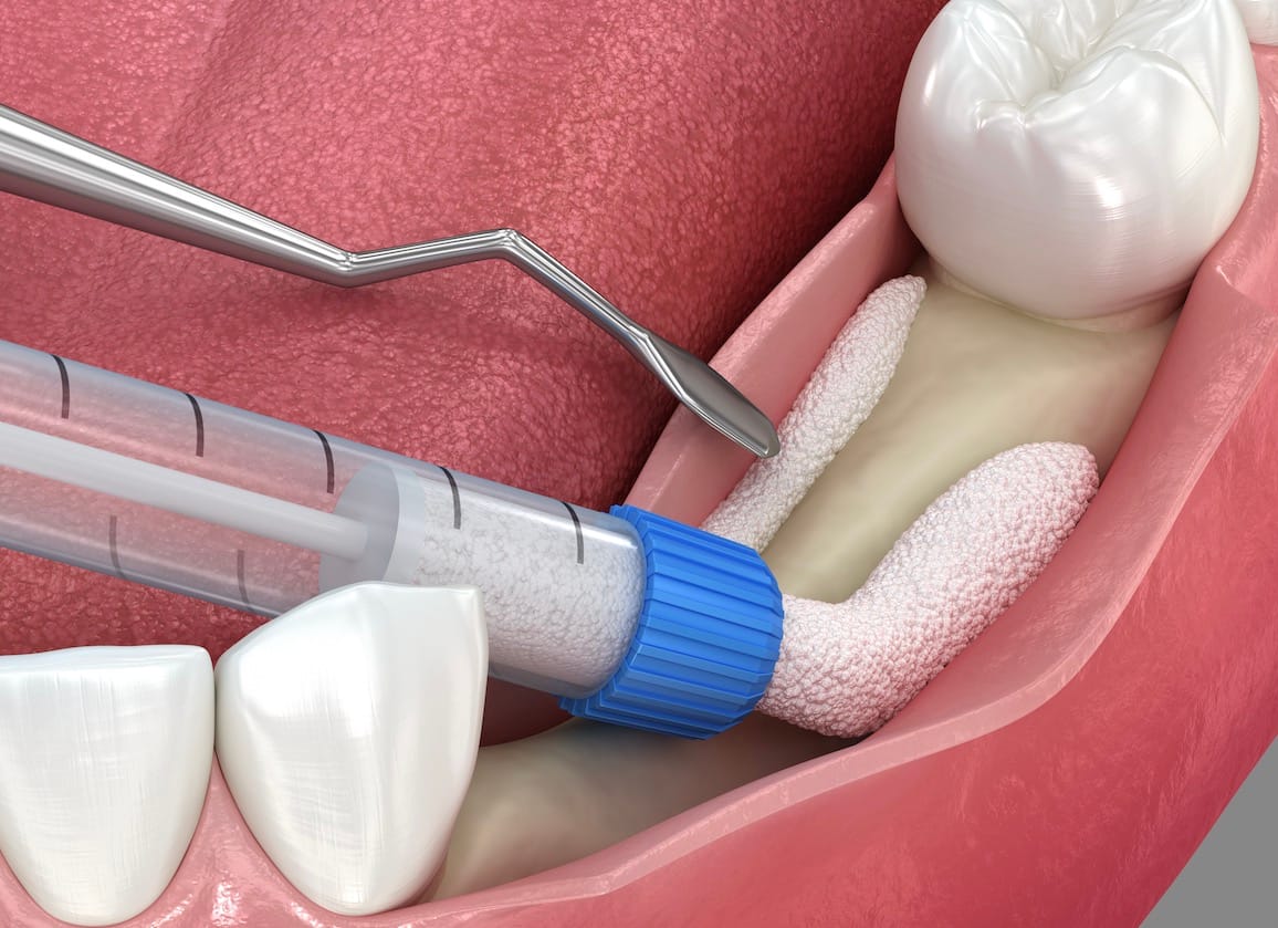 Knochenaufbau Bad Homburg – Die sichere Basis für Ihr Implantat