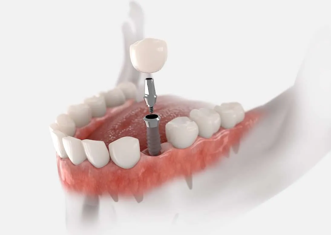 Zahnimplantate mit 3D Technologie unsere Expertise - Zahnarzt Bad Homburg
